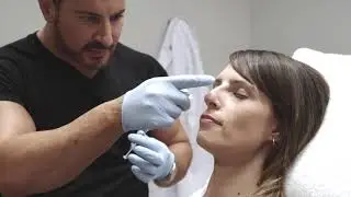 Non Surgical Nose Job by Dr. Pavlou in Vancouver