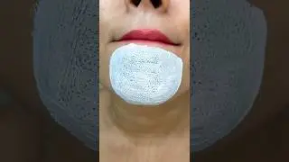 easy way to remove chin Whitehead & blackhead at home remedy&hearts;️#shorts #youtubeshorts #trendinghacks