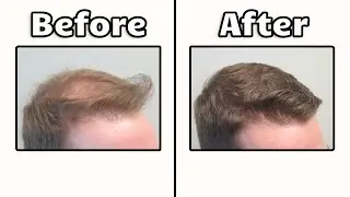 How To Reverse Hair Loss In 2026 (Full Guide)