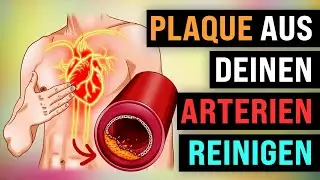 5 Wege, um PLAQUE aus den ARTERIEN zu entfernen