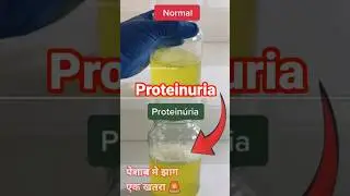 Normal Urine Vs Proteinuria😱 Protein in Urine Differences #proteinuria #urineprotein #urineanalysis