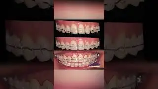 STEP DOWN BENDS - ORTHODONTIC TIPS #Shorts