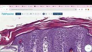 PITYRIASIS ROSEA, Psoriasis, clear cell acanthoma, Lichen planus, BLK, LICHEN SCLEROSUS