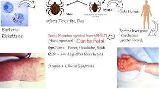 Spotted fever group rickettsioses (spotted fevers), Rocky Mountain spotted fever