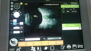 Retiwave 1000 Digital Ultrasonic Eye System Portable Ophthalmic Ultrasound A/B Scanner