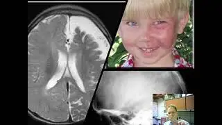 Seizure disorders in children – good and bad outcomes - Dr. K. Ess