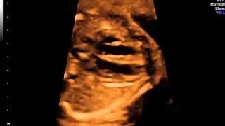 Ecocardiografia: cuore fetale 4D con tecnica VCI