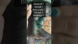 2 Simple Ingredients to Stop Dandruff ❌✨||DIY REMEDY#viral#shortsfeed#shorts#trending#asmr#haircare