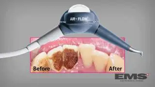 The AIR-FLOW® Dynamic Duo from EMS