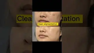 #Pigmentation #Clearskin #Avarampoo #soap #Neemgel