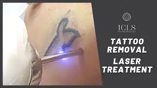 Laser Tattoo Removal | ICLS Dermatology & Plastic Surgery