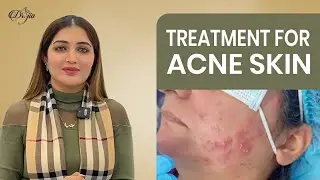 Treatment For Acne Skin || Treatment For Active Acne || Best Dermatologist and Skin Care Specialist