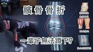 髕骨粉碎性骨折｜醫師竟然說一輩子無法蹲下!?｜但是一年後結局竟然反轉