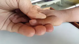 Clubbing of  fingernails in a cyanotic child tetralogy of Fallot TOF