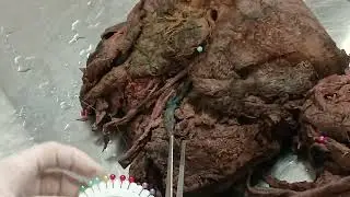 Triangulo digastrico 