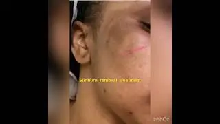 PERMANENT SUNBURN REMOVAL TREATMENT