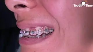 Braces checkups - ZingO string/crimp stop/rotation wedge - Tooth Time Family Dentistry New Braunfels