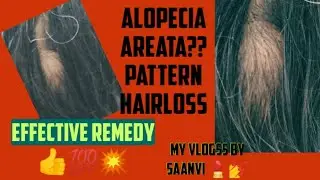 💯 Alopecia areata||Himalaya Hairzone||Malayalam||My Vlogss by Saanvi 💅💄🔥