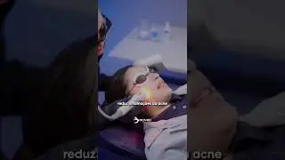 LASERPULSE NA ACNE