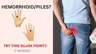 SuJok Therapy for Hemorrhoids | Piles | Acupressure | Seed therapy