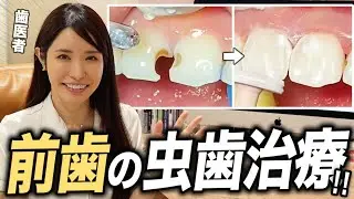 前歯の虫歯はどうしたらいい！？歯医者が徹底解説【歯科医 / コンポジットレジン / 詰め物】