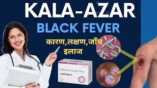 kala azar (black fever) | kala azar disease in hindi | kala azar treatment