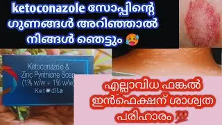 ketoconazole& zinc pyrithione soap review Malayalam |ketoconazol uses|fungal infections