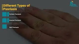 Psoriasis: Causes, Symptoms, Diagnosis & Treatment