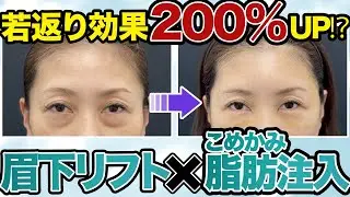 眉下＋こめかみ脂肪注入　キズをカバーし若返り効果もアップ　#ジェントル滝澤 #眉下リフト #リポリフティング