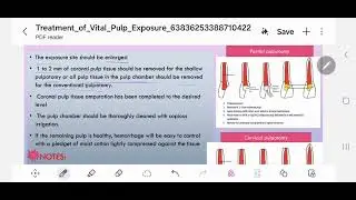 pediatric (( Treatment of vital pulp exposure ))