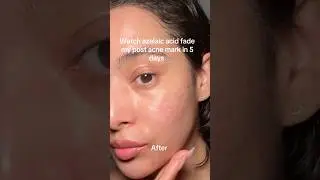 Azelaic Acid: The Underrated Skincare Hero for Acne & Hyperpigmentation!