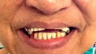 Dentures direct Perth