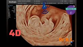 ✨ &Eacute;chographie de grossesse &agrave; 10 SA : Une fen&ecirc;tre sur la vie ! ✨
