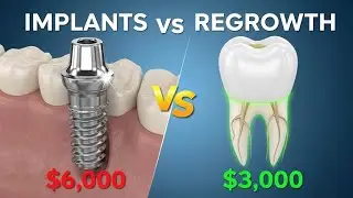 Tooth Regeneration vs Dental Implants: Cost Comparison 2025 | Medical Miracle