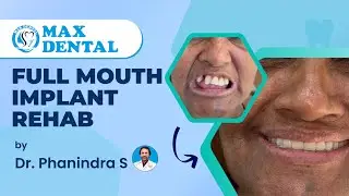 Full mouth implant rehab By Dr Phanindra at Max Dental. Nizamabad #phanindra_sandebiksham #maxdental