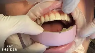 Temporary Veneers Transform Smile