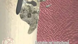 LANAP Animation