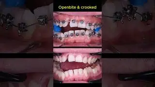 Braces for openbite and crooked teeth #braces #dentist #orthodontist
