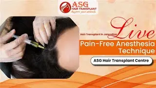 Hair Transplant in Jalandhar &ndash; Live: Pain-Free Anesthesia Technique | ASG Hair Transplant Centre