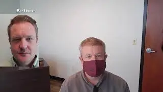 Bethesda, Maryland Natural Hair Transplant | Get a Great Hair Transplant in Bethesda.
