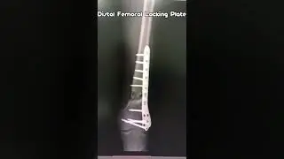 Xray-Distal Femoral Locking Plate - DFLP