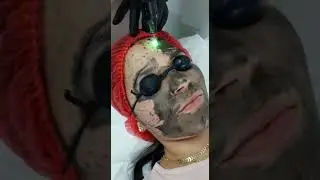 PEELING A LASER