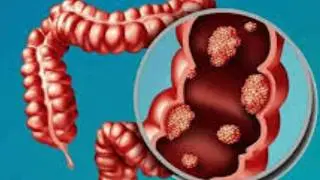 Bleeding Per rectum \ Anus And Only Treatment