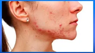 Hablamos de cambios en la piel por desequilibrio hormonal