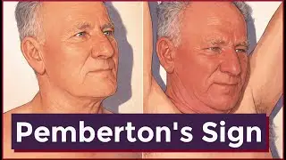 Pemberton's Sign | Thoracic Inlet Syndrome