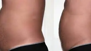 Strawberry Laser Lipo