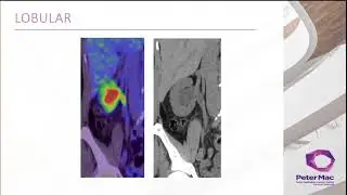 Bone response assessment in Breast Cancer with Dr Kate Moodie