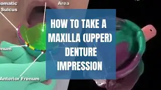 How to take maxilla (upper) denture Impressions