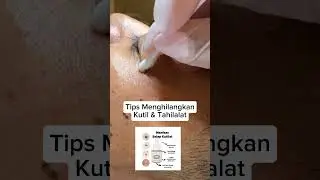 #fypp #tahilalat #kutil tips dan cara menghilangkan kutil dan tahilalat diwajah #viralvideo