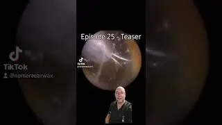 Episode 25 teaser #earwaxremoval #satisfying #ear #viral #microsuction #fyp